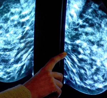 Breast cancer radiotherapy options...Embargoed to 0001 Wednesday January 28
File photo dated 15/06/06 of a picture of a mammogram showing a woman's breast, as some women with breast cancer could be spared debilitating radiotherapy after undergoing surgery without harming their chances of survival, new research suggests. PRESS ASSOCIATION Photo. Issue date: Wednesday January 28, 2015. Older women with some types of early-stage cancers who undergo "breast-conserving surgery" and post-op hormone therapy gain very little added benefit from radiation treatment, according to a team from the University of Edinburgh. See PA story HEALTH Breast. Photo credit should read: Rui Vieira/PA Wire