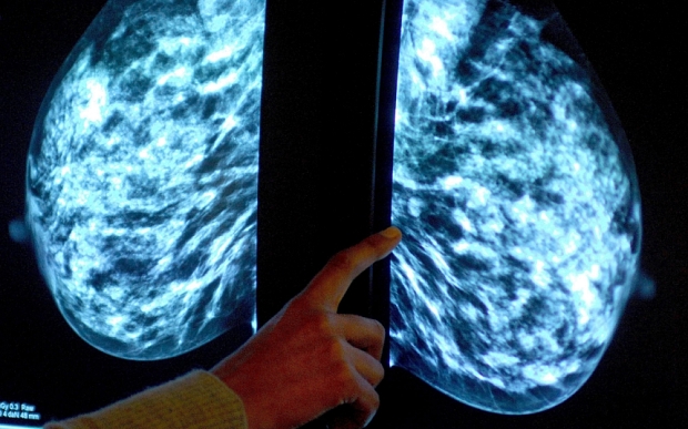Breast cancer radiotherapy options...Embargoed to 0001 Wednesday January 28
File photo dated 15/06/06 of a picture of a mammogram showing a woman's breast, as some women with breast cancer could be spared debilitating radiotherapy after undergoing surgery without harming their chances of survival, new research suggests. PRESS ASSOCIATION Photo. Issue date: Wednesday January 28, 2015. Older women with some types of early-stage cancers who undergo "breast-conserving surgery" and post-op hormone therapy gain very little added benefit from radiation treatment, according to a team from the University of Edinburgh. See PA story HEALTH Breast. Photo credit should read: Rui Vieira/PA Wire